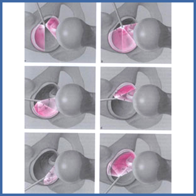 Hüftgelenksarthroskopie