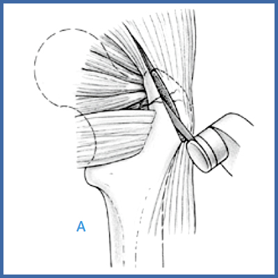Chirurgische Hüftluxation