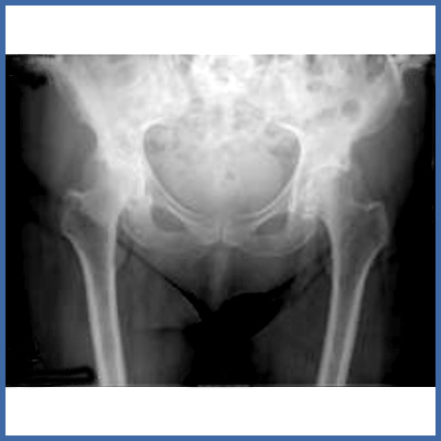 Hüftgelenksprothese