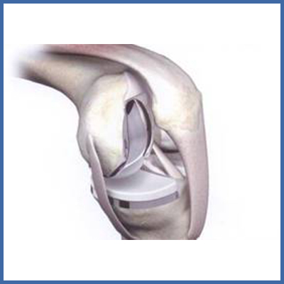 Unikompartimentäre Prothese