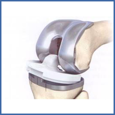 Kniegelenkstotalprothese